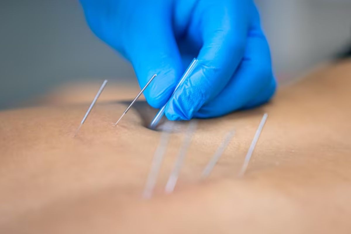 acupuncture needles placed in the skin to promote relaxation and stress relief.